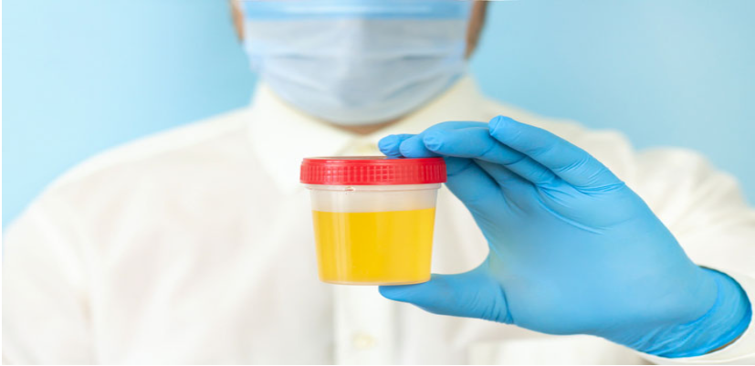 Urine Analysis